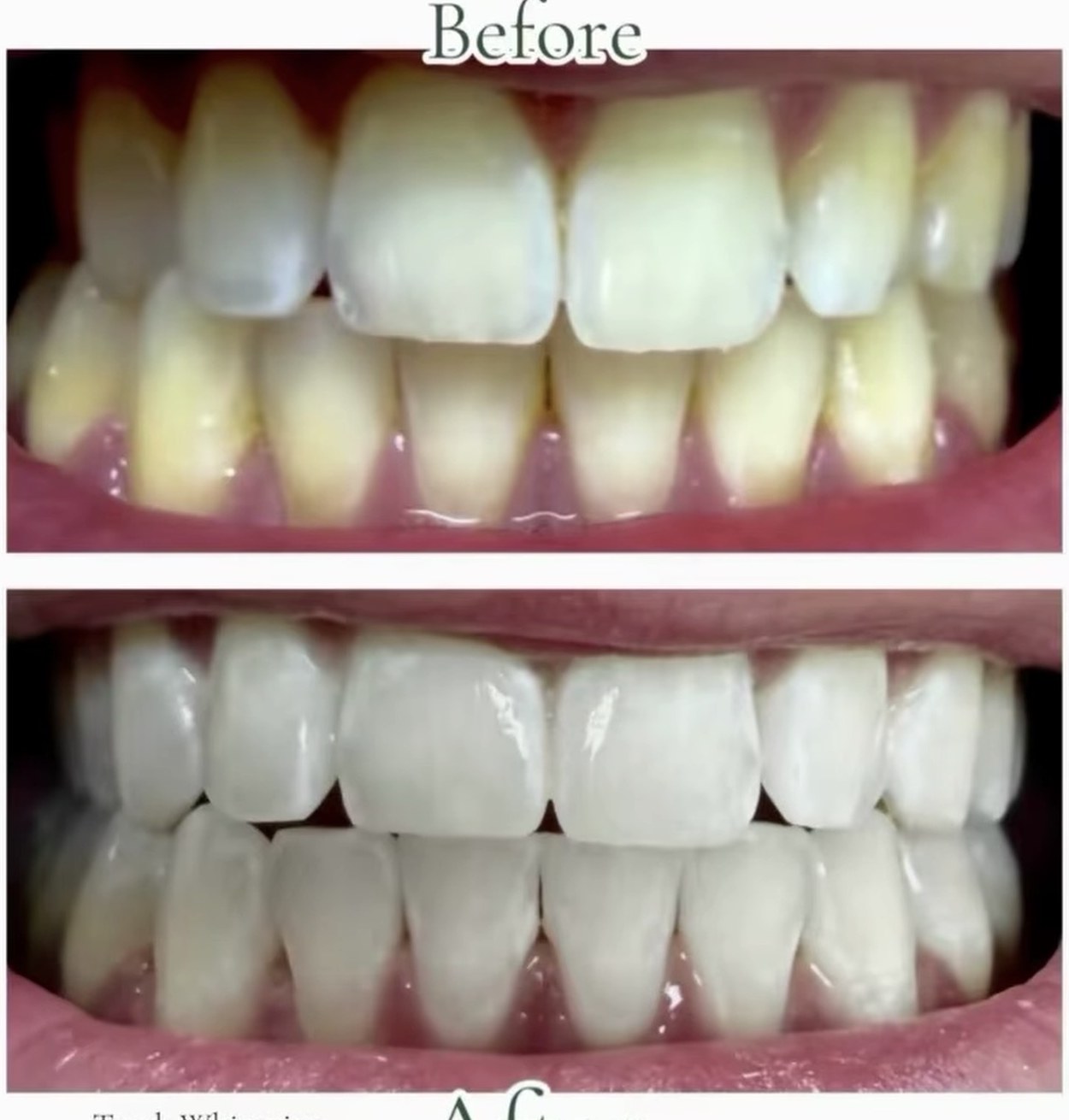 Before and after teeth whitening example from office advertisement