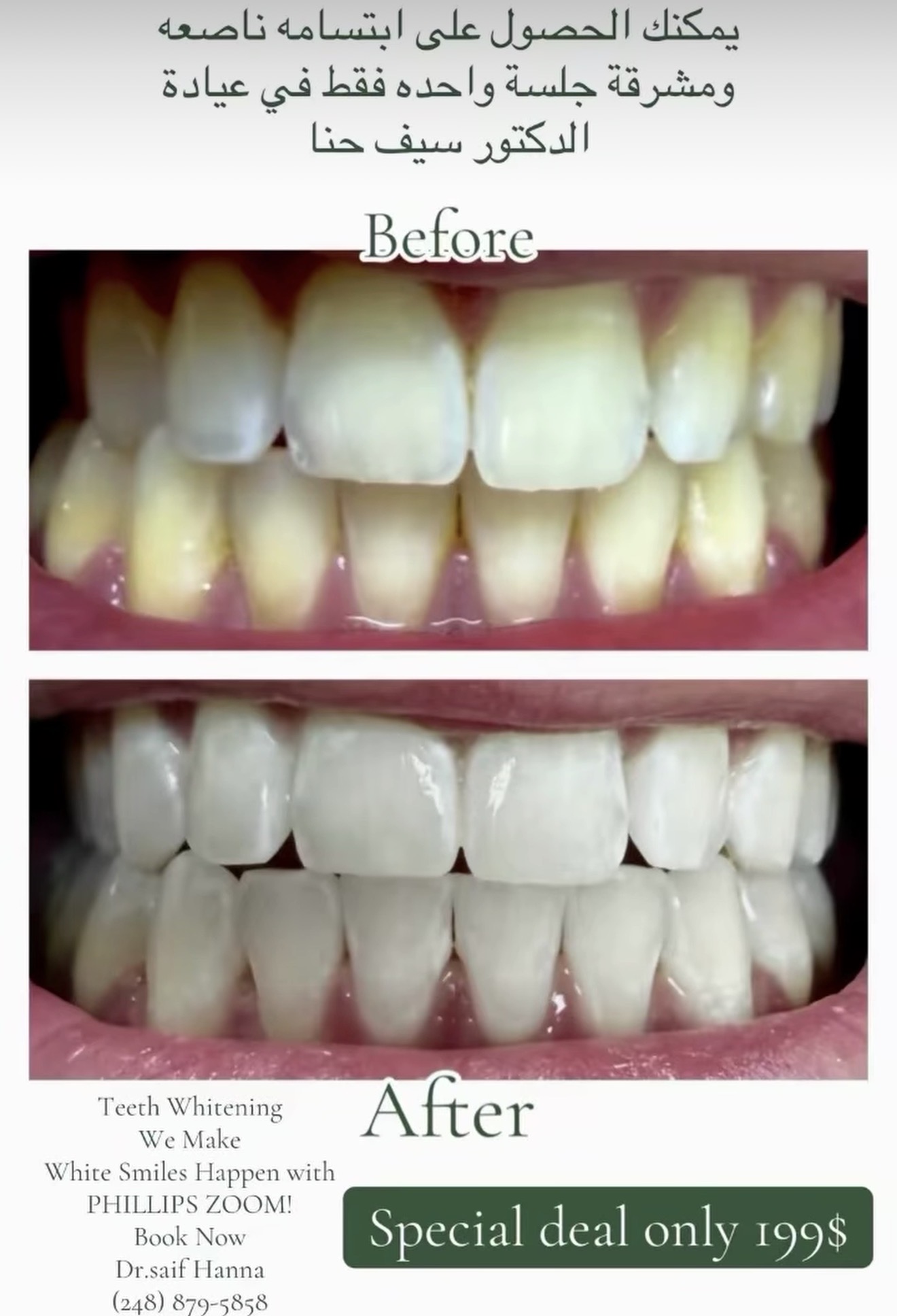 Teeth whitening before and after promotion
